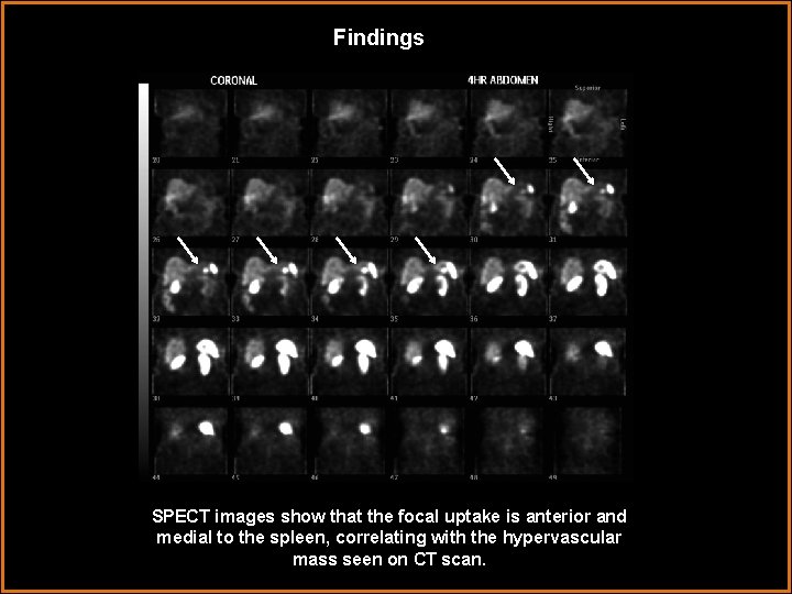 Findings SPECT images show that the focal uptake is anterior and medial to the
