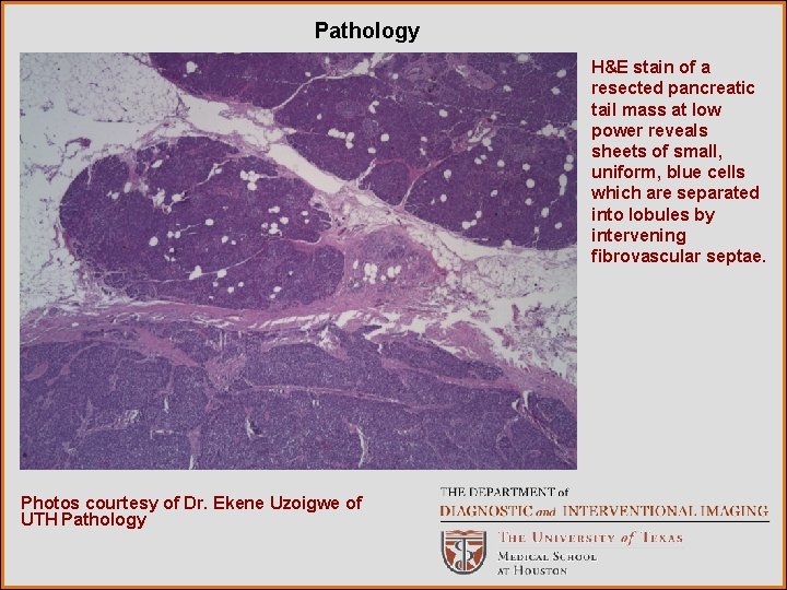 Pathology H&E stain of a resected pancreatic tail mass at low power reveals sheets