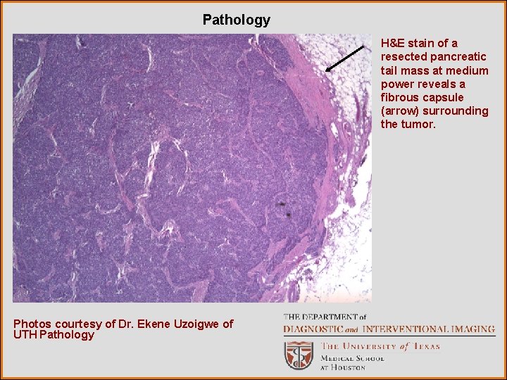 Pathology H&E stain of a resected pancreatic tail mass at medium power reveals a