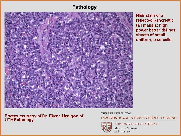 Pathology H&E stain of a resected pancreatic tail mass at high power better defines