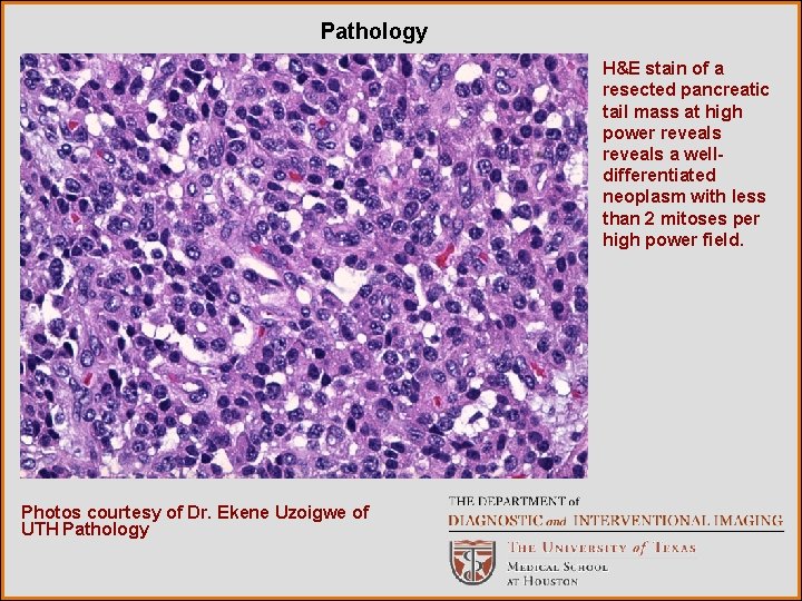 Pathology H&E stain of a resected pancreatic tail mass at high power reveals a