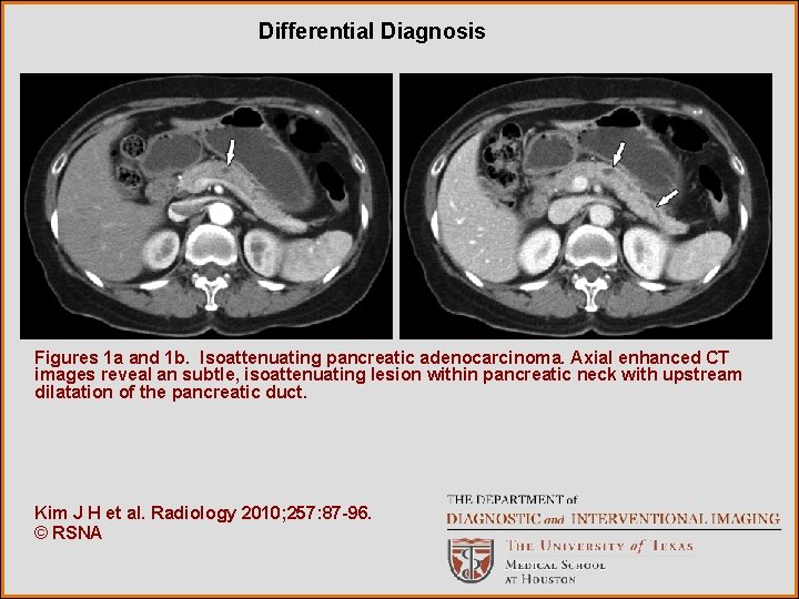 Differential Diagnosis Figures 1 a and 1 b. Isoattenuating pancreatic adenocarcinoma. Axial enhanced CT