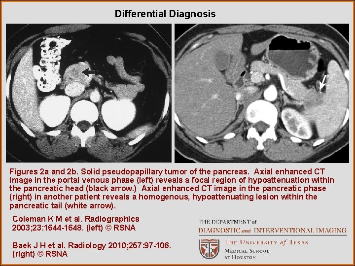 Differential Diagnosis Figures 2 a and 2 b. Solid pseudopapillary tumor of the pancreas.