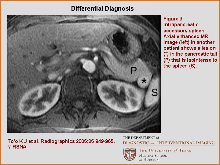 Differential Diagnosis Figure 3. Intrapancreatic accessory spleen. Axial enhanced MR image (left) in another