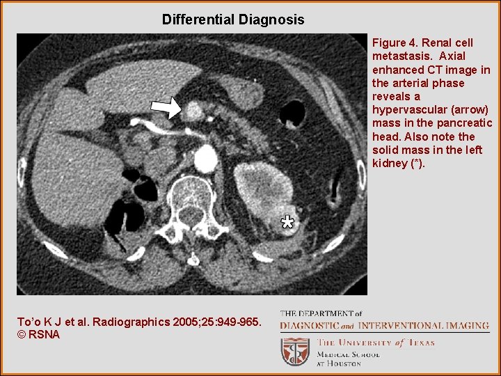 Differential Diagnosis Figure 4. Renal cell metastasis. Axial enhanced CT image in the arterial