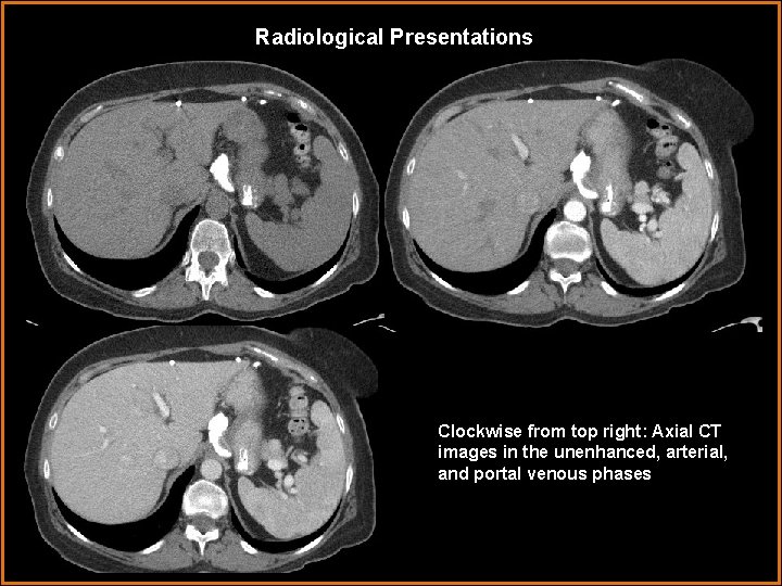 Radiological Presentations Clockwise from top right: Axial CT images in the unenhanced, arterial, and