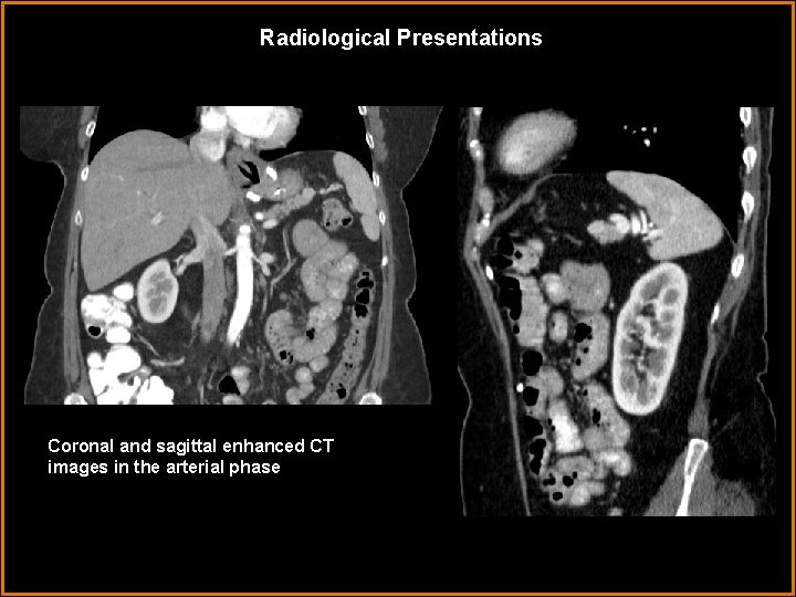Radiological Presentations Coronal and sagittal enhanced CT images in the arterial phase 