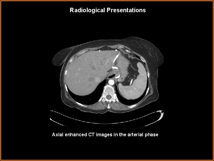 Radiological Presentations Axial enhanced CT images in the arterial phase 