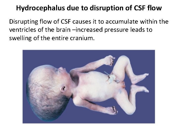 Hydrocephalus due to disruption of CSF flow Disrupting flow of CSF causes it to