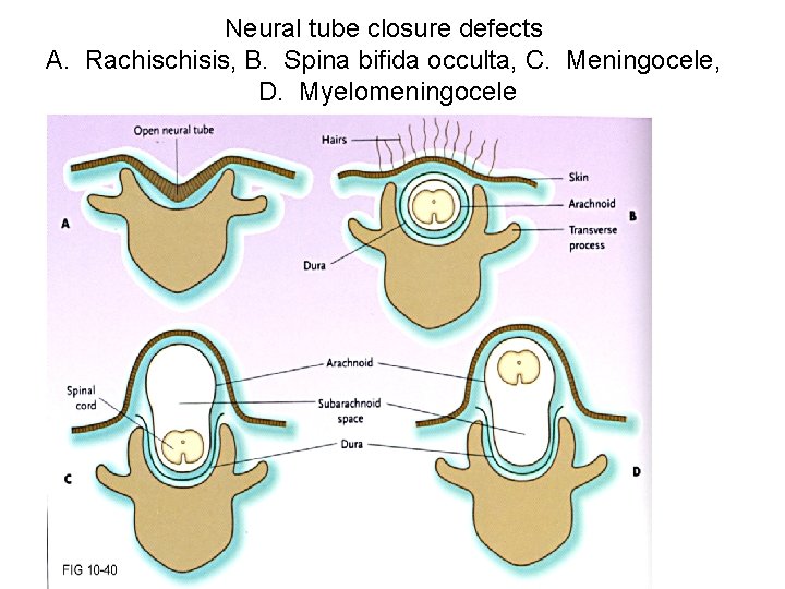Neural tube closure defects A. Rachisis, B. Spina bifida occulta, C. Meningocele, D. Myelomeningocele Neural tube closure defects A. Rachisis, B. Spina bifida occulta, C. Meningocele, D. Myelomeningocele