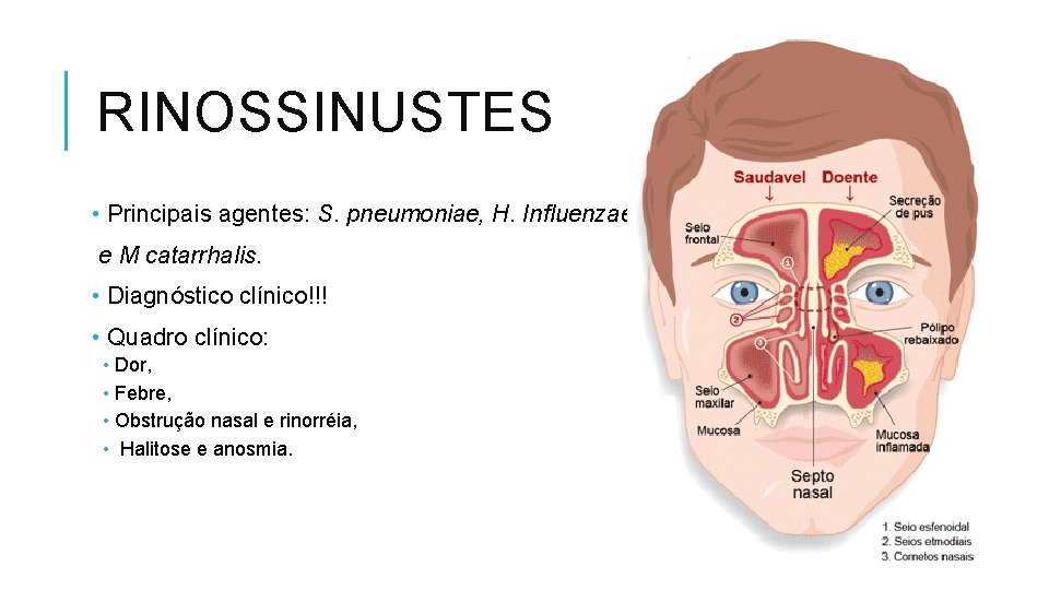 RINOSSINUSTES • Principais agentes: S. pneumoniae, H. Influenzae e M catarrhalis. • Diagnóstico clínico!!!