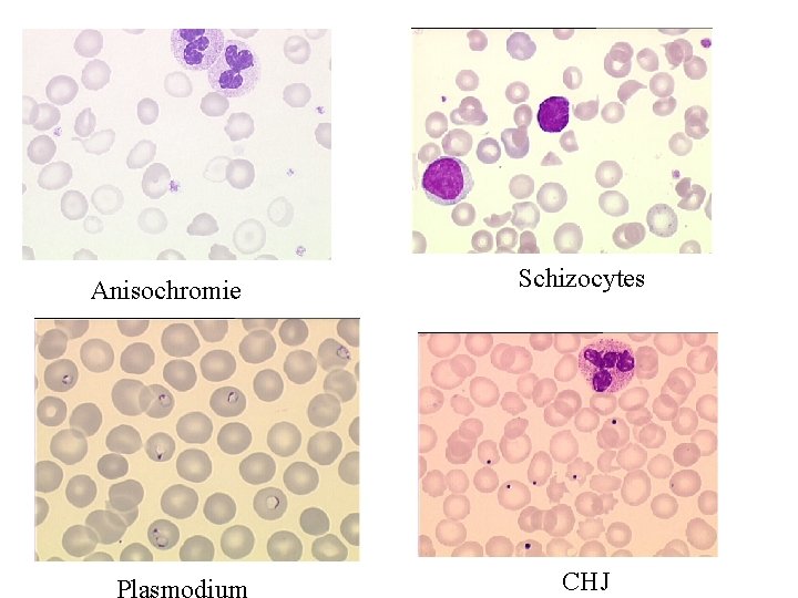 Anisochromie Schizocytes CHJ 