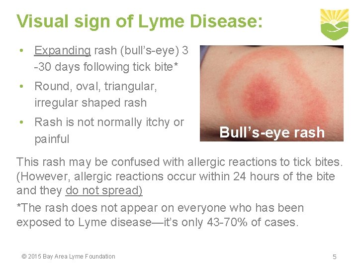 Visual sign of Lyme Disease: • Expanding rash (bull’s-eye) 3 -30 days following tick