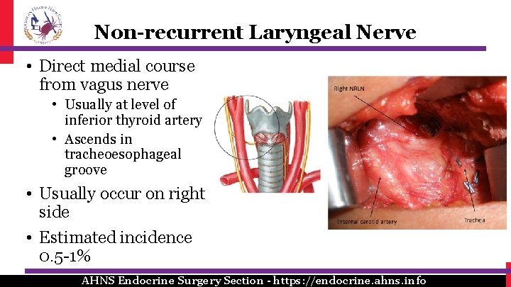 Non-recurrent Laryngeal Nerve • Direct medial course from vagus nerve • Usually at level Non-recurrent Laryngeal Nerve • Direct medial course from vagus nerve • Usually at level