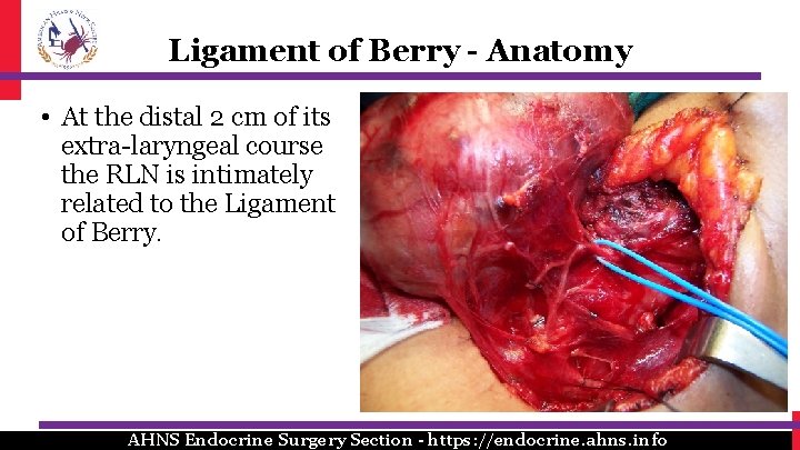 Ligament of Berry - Anatomy • At the distal 2 cm of its extra-laryngeal