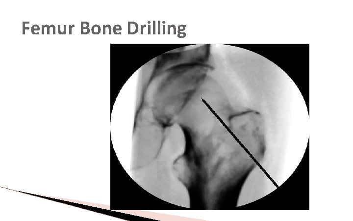 Femur Bone Drilling Femur Bone Drilling