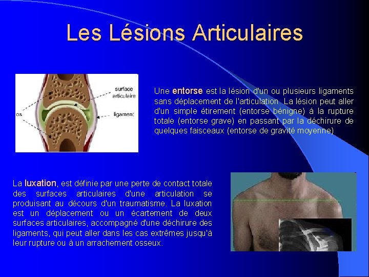 Les Lésions Articulaires Une entorse est la lésion d'un ou plusieurs ligaments sans déplacement