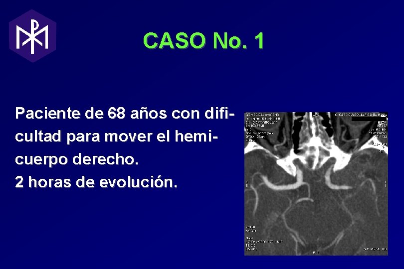 CASO No. 1 Paciente de 68 años con dificultad para mover el hemicuerpo derecho. CASO No. 1 Paciente de 68 años con dificultad para mover el hemicuerpo derecho.
