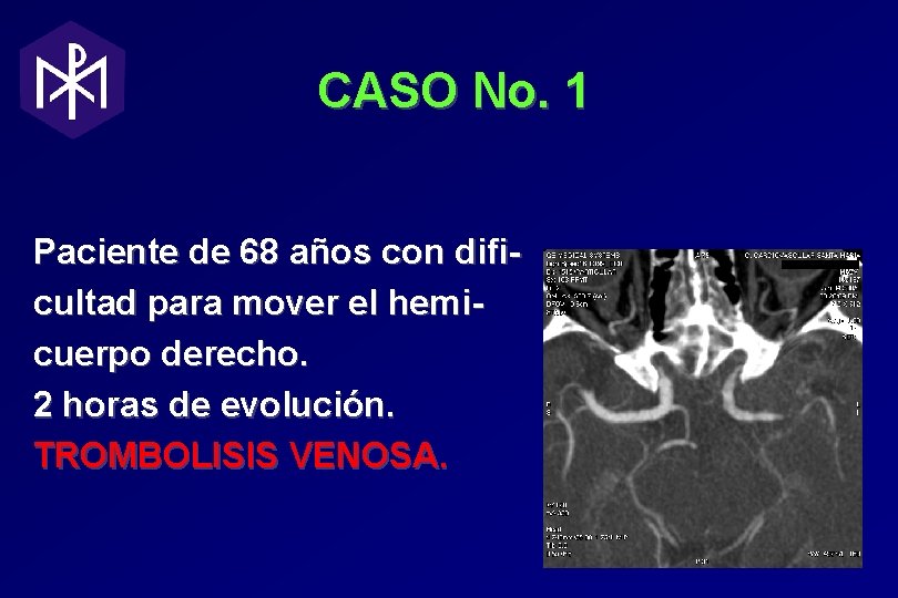 CASO No. 1 Paciente de 68 años con dificultad para mover el hemicuerpo derecho. CASO No. 1 Paciente de 68 años con dificultad para mover el hemicuerpo derecho.
