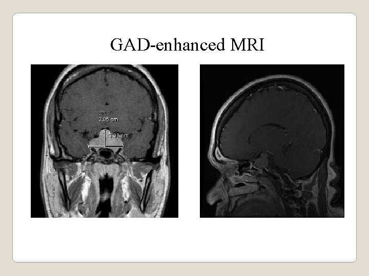 GAD-enhanced MRI 