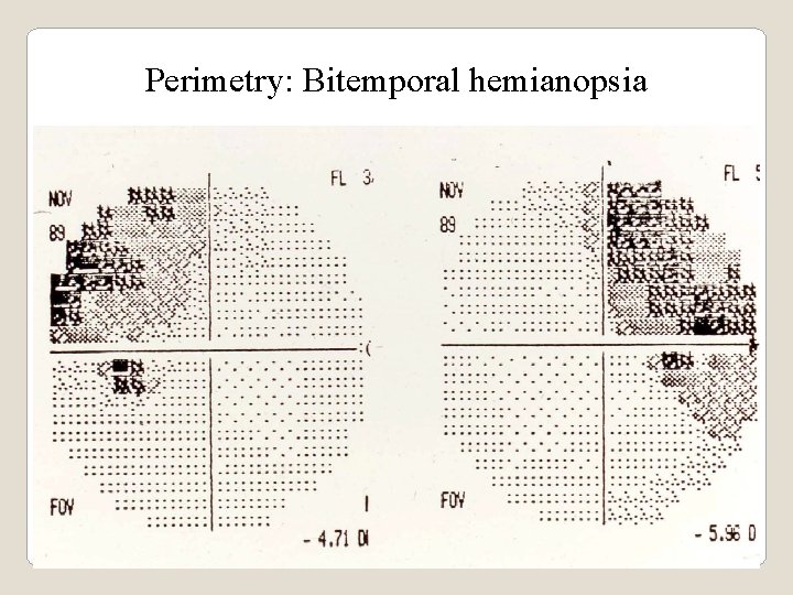 Perimetry: Bitemporal hemianopsia 