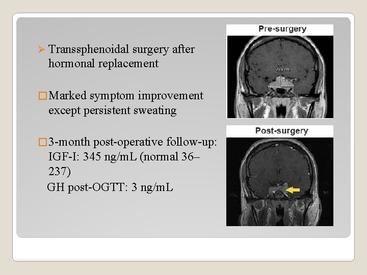 Ø Transsphenoidal surgery after hormonal replacement � Marked symptom improvement except persistent sweating �