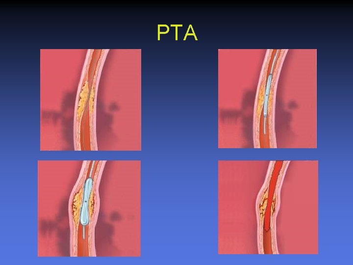 PTA 