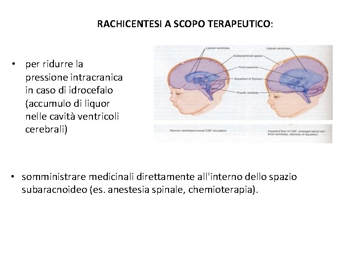 RACHICENTESI A SCOPO TERAPEUTICO: • per ridurre la pressione intracranica in caso di idrocefalo