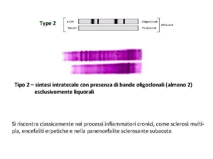 Type 2 Tipo 2 – sintesi intratecale con presenza di bande oligoclonali (almeno 2)