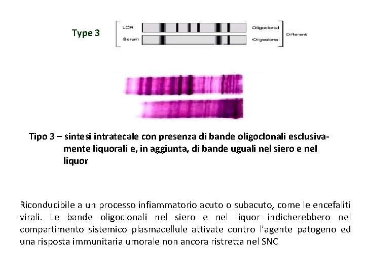 Type 3 Tipo 3 – sintesi intratecale con presenza di bande oligoclonali esclusivamente liquorali