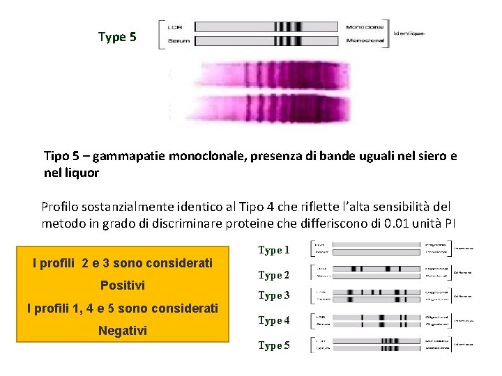 Type 5 Tipo 5 – gammapatie monoclonale, presenza di bande uguali nel siero e