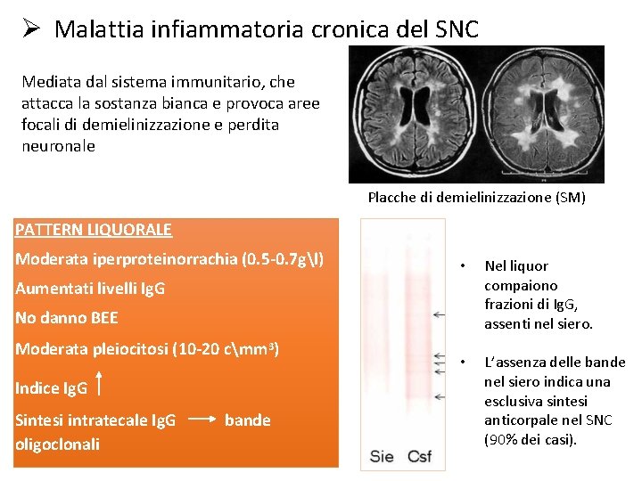 Ø Malattia infiammatoria cronica del SNC Mediata dal sistema immunitario, che attacca la sostanza
