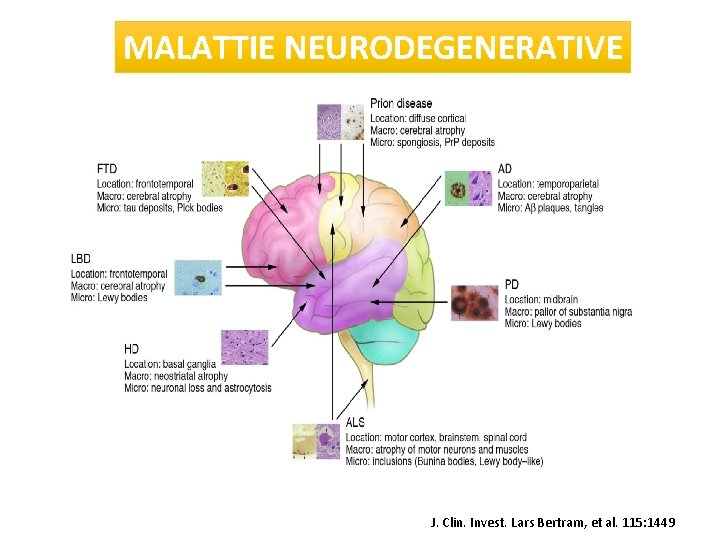 MALATTIE NEURODEGENERATIVE J. Clin. Invest. Lars Bertram, et al. 115: 1449 