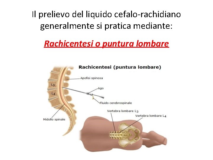 Il prelievo del liquido cefalo-rachidiano generalmente si pratica mediante: Rachicentesi o puntura lombare 