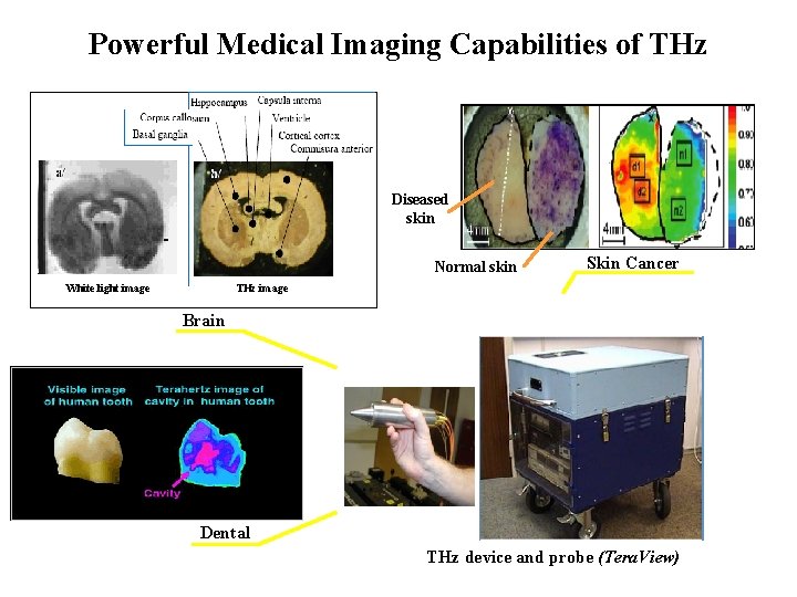 Powerful Medical Imaging Capabilities of THz Diseased skin Normal skin White light image Skin