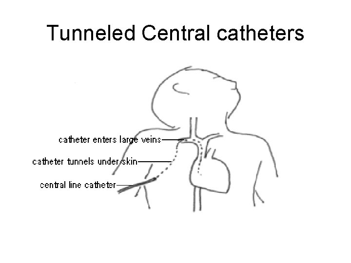 Tunneled Central catheters 