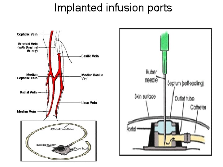 Implanted infusion ports 