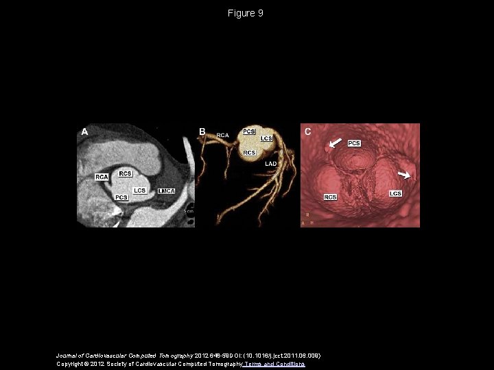 Figure 9 Journal of Cardiovascular Computed Tomography 2012 648 -59 DOI: (10. 1016/j. jcct.