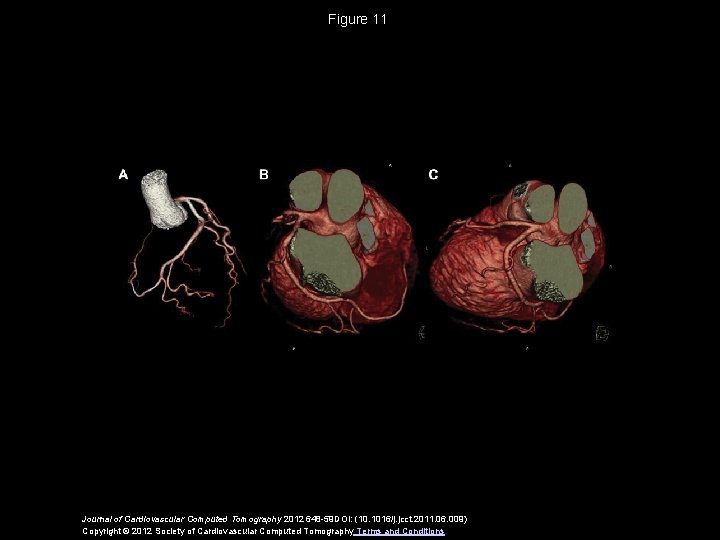 Figure 11 Journal of Cardiovascular Computed Tomography 2012 648 -59 DOI: (10. 1016/j. jcct.