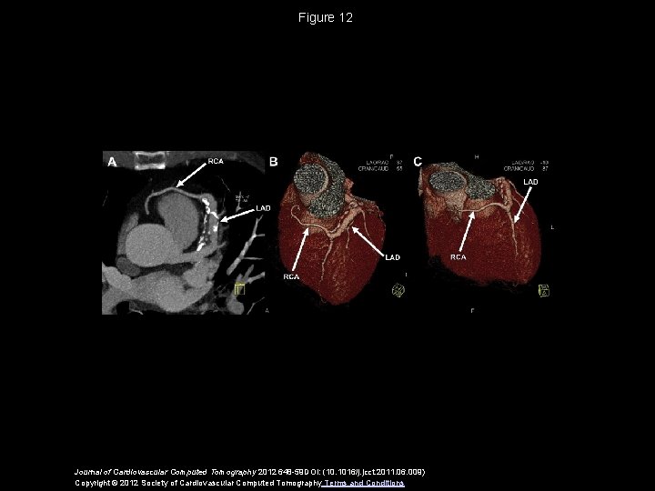 Figure 12 Journal of Cardiovascular Computed Tomography 2012 648 -59 DOI: (10. 1016/j. jcct.