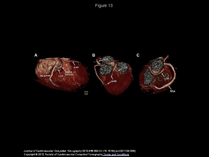 Figure 13 Journal of Cardiovascular Computed Tomography 2012 648 -59 DOI: (10. 1016/j. jcct.