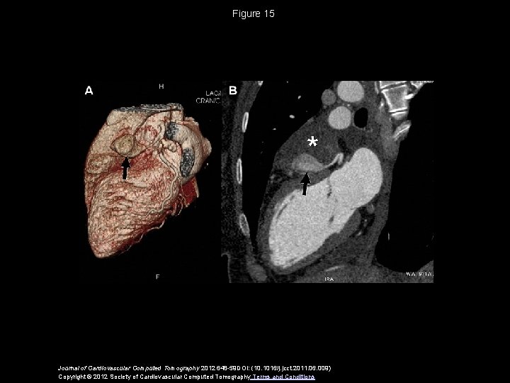 Figure 15 Journal of Cardiovascular Computed Tomography 2012 648 -59 DOI: (10. 1016/j. jcct.