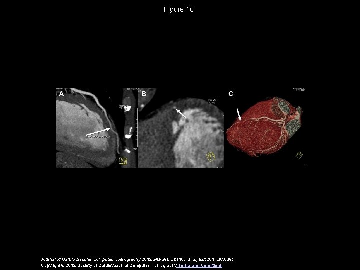 Figure 16 Journal of Cardiovascular Computed Tomography 2012 648 -59 DOI: (10. 1016/j. jcct.