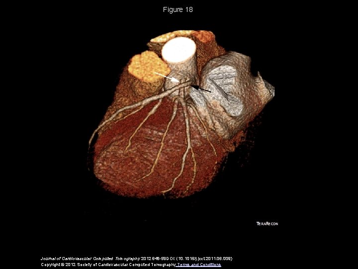 Figure 18 Journal of Cardiovascular Computed Tomography 2012 648 -59 DOI: (10. 1016/j. jcct.