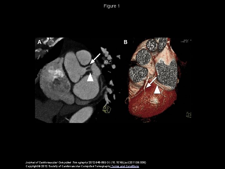 Figure 1 Journal of Cardiovascular Computed Tomography 2012 648 -59 DOI: (10. 1016/j. jcct.
