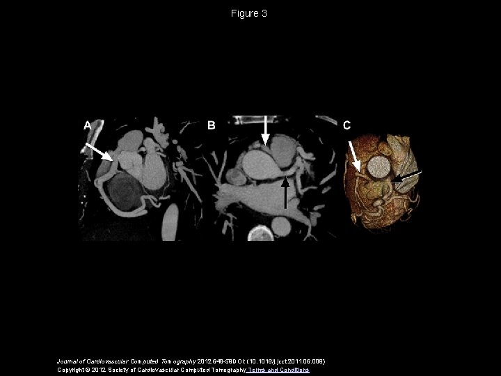 Figure 3 Journal of Cardiovascular Computed Tomography 2012 648 -59 DOI: (10. 1016/j. jcct.