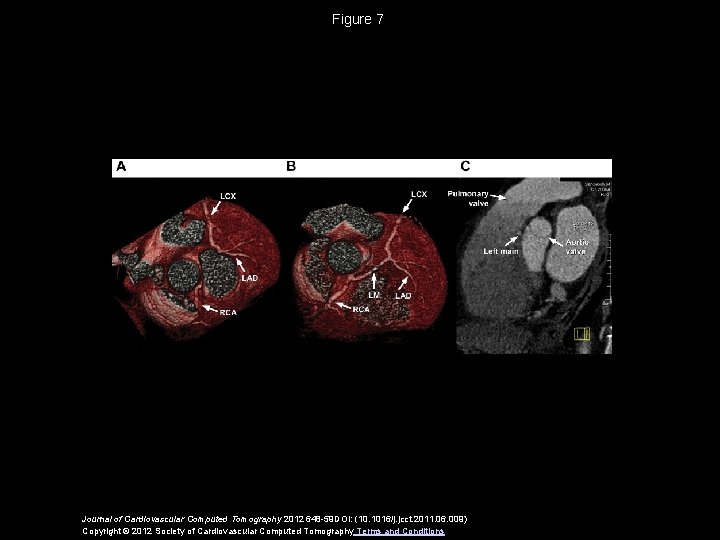 Figure 7 Journal of Cardiovascular Computed Tomography 2012 648 -59 DOI: (10. 1016/j. jcct.