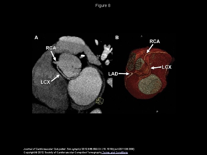 Figure 8 Journal of Cardiovascular Computed Tomography 2012 648 -59 DOI: (10. 1016/j. jcct.