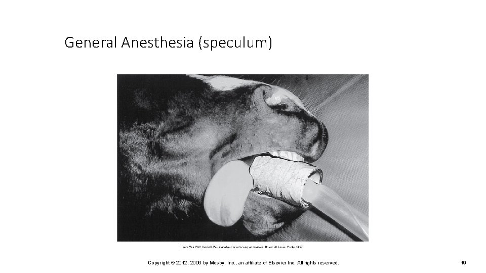 General Anesthesia (speculum) Copyright © 2012, 2006 by Mosby, Inc. , an affiliate of
