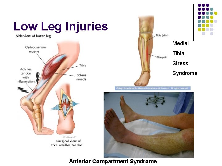 Low Leg Injuries Medial Tibial Stress Syndrome Anterior Compartment Syndrome Low Leg Injuries Medial Tibial Stress Syndrome Anterior Compartment Syndrome
